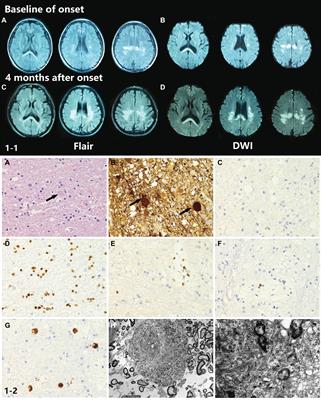 A Novel Splicing Mutation in the CSF1R Gene in a Family With Hereditary Diffuse Leukoencephalopathy With Axonal Spheroids